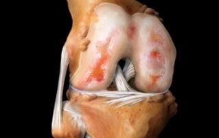 что такое артроз коленного сустава