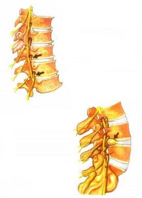 иллюстрация остеохондроза позвоночника